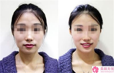 南宁市做达拉斯隆鼻哪里整形医院好(南宁贞韩解锁榜一)
