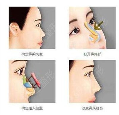 广西医科大学第三附属医院整形科做鼻子怎么样?60天前后果不错!